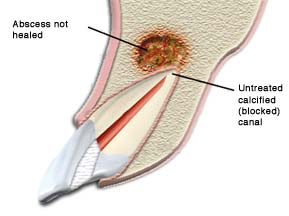 Endodontic Retreatment illustration