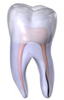 Vertical Root Fracture illustration