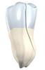 Split Tooth Illustration